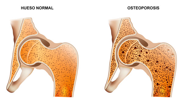 Diferencia entre un hueso sano y uno con osteoporosis