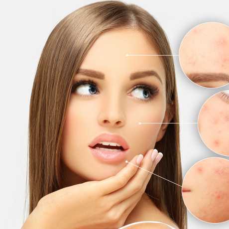 tratamiento acne