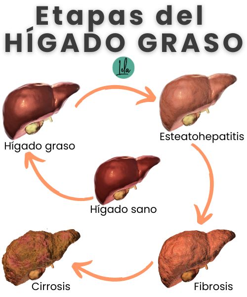 Etapas higado graso